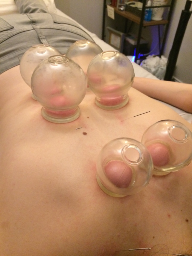 Cupping_HobokenGirl