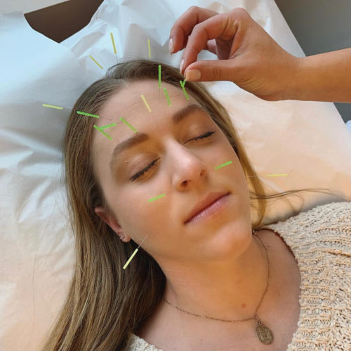nj acupuncture center jersey city bayonne sinus headaches