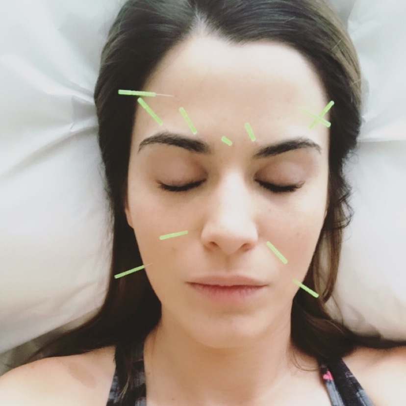 nj acupuncture center sinus treatment