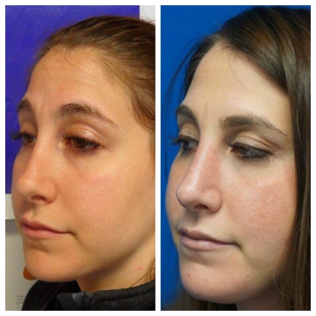 Doctor-Zhuravsky-Rhinoplasty-Before-After-Hoboken-Plastic-Srugery