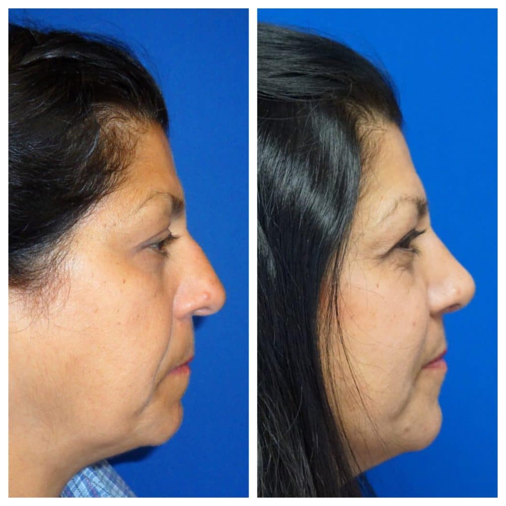 Doctor-Zhuravsky-Rhinoplasty-Before-After-Hoboken-Plastic-Srugery