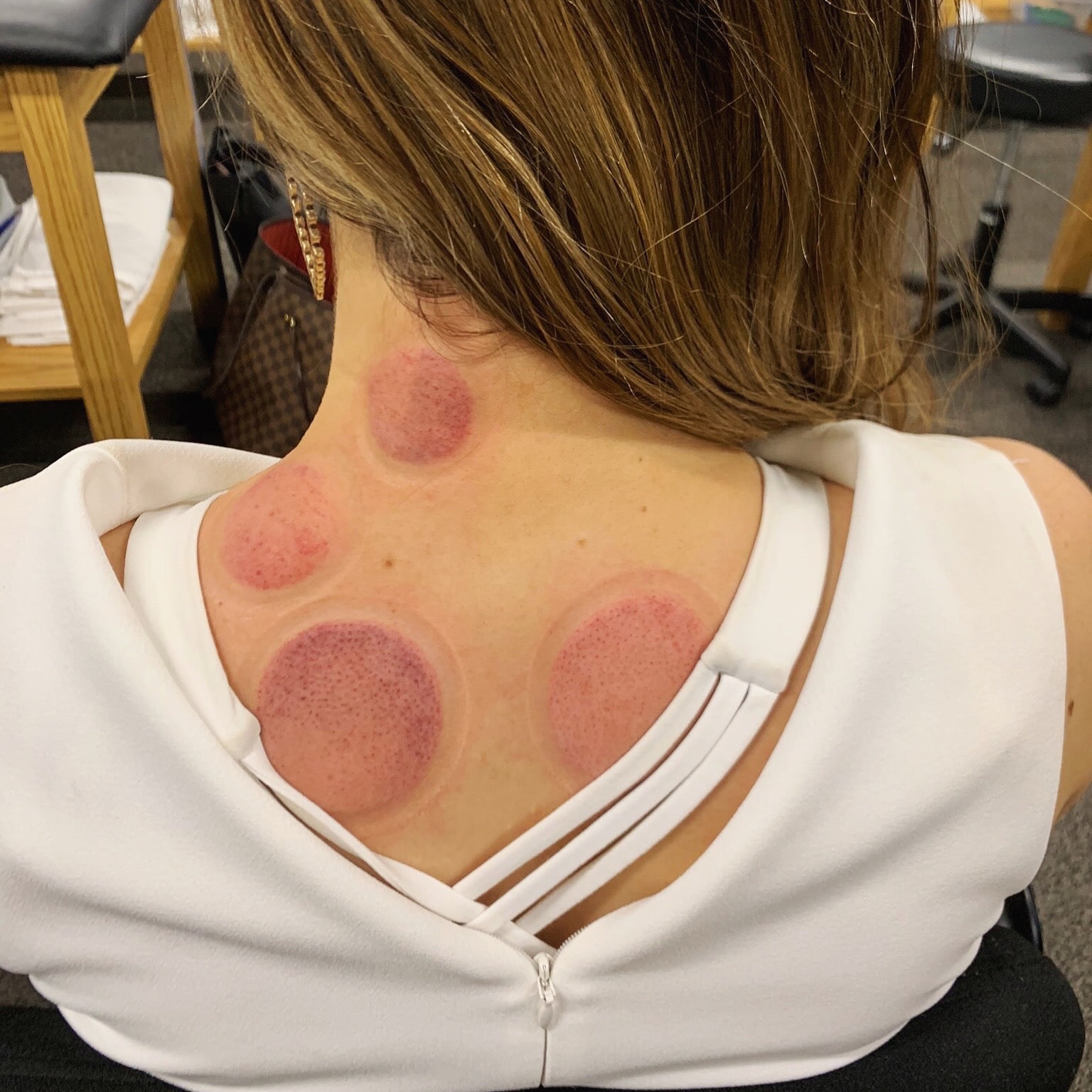 excel physicial therapy cupping 2