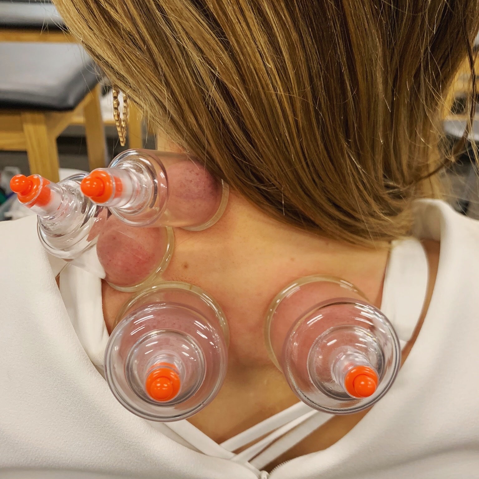 excel physical therapy cupping