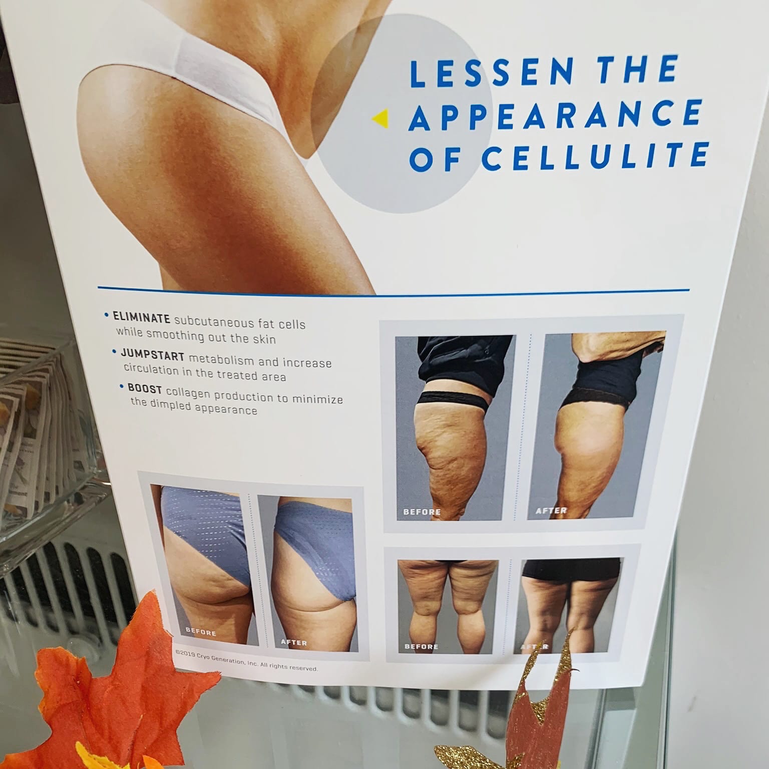 cryo slimming