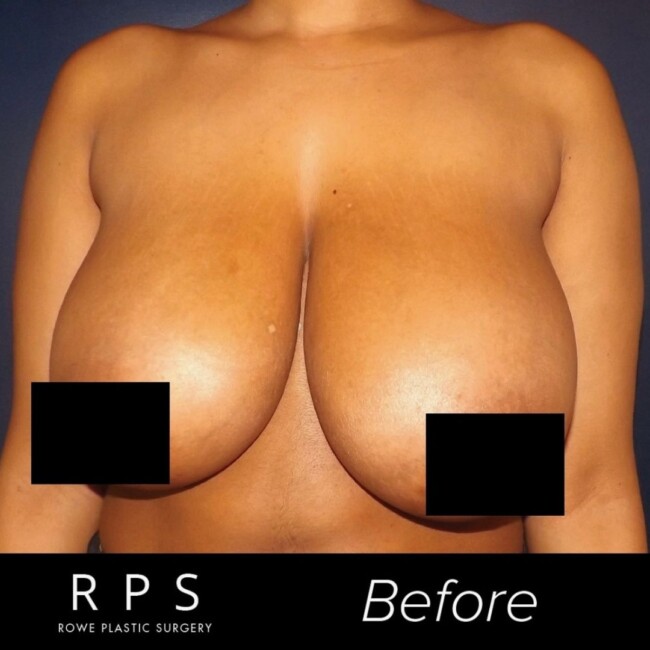attain med spa rowe plastic surgery hoboken event breast reductions